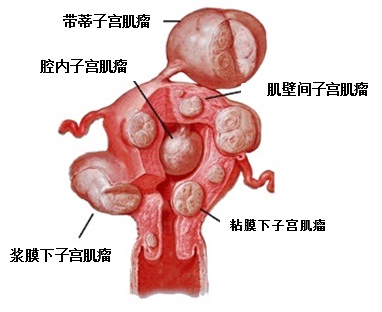 籽宫肌瘤呼病理住房_杨宁介入医学网