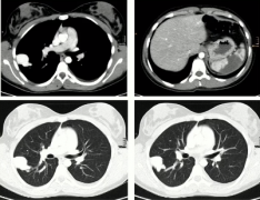 肺动静脉畸形的CT检查